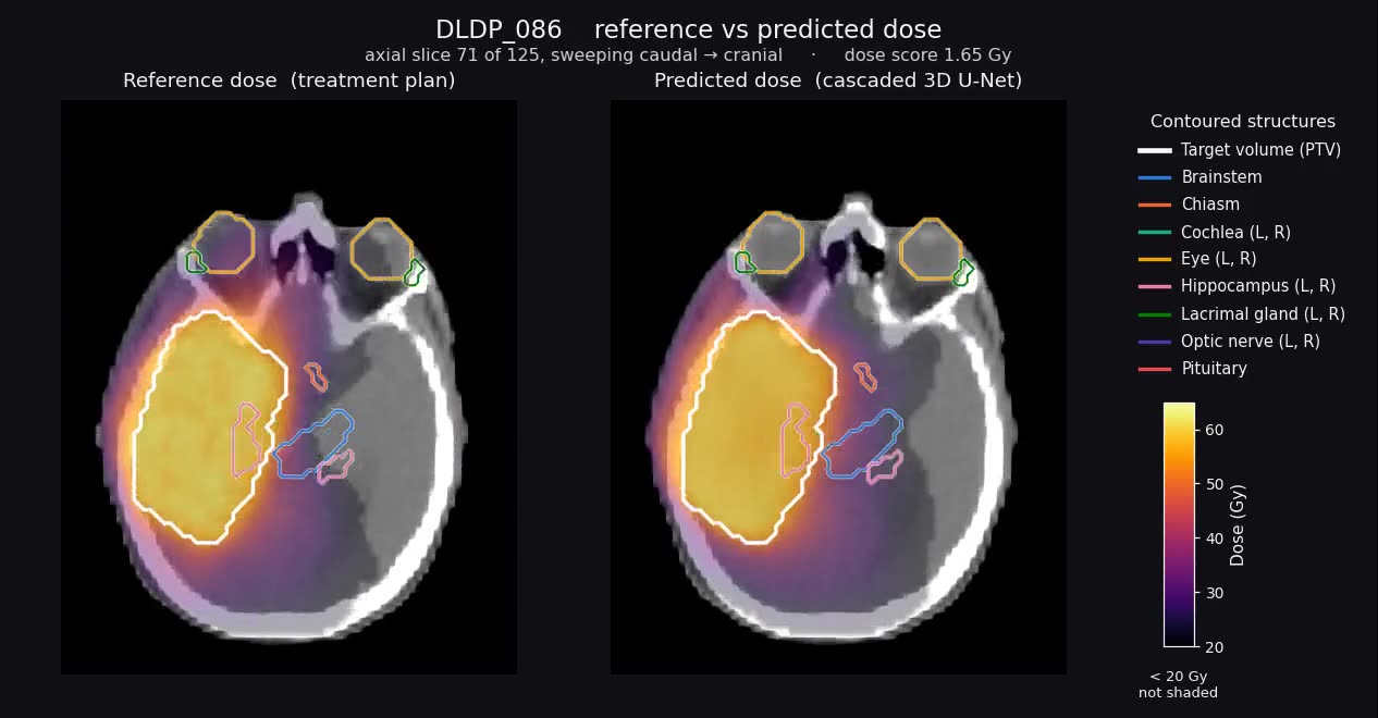One axial slice of a glioblastoma case: the planned dose on the left and the model's predicted dose on the right, both as a heat map over the planning CT, with the target volume and organs at risk outlined.